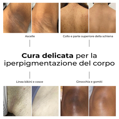 Risultati prima e dopo del trattamento delicato per l’iperpigmentazione su ascelle, schiena, linea bikini, ginocchia e gomiti con il siero Lumisilk.