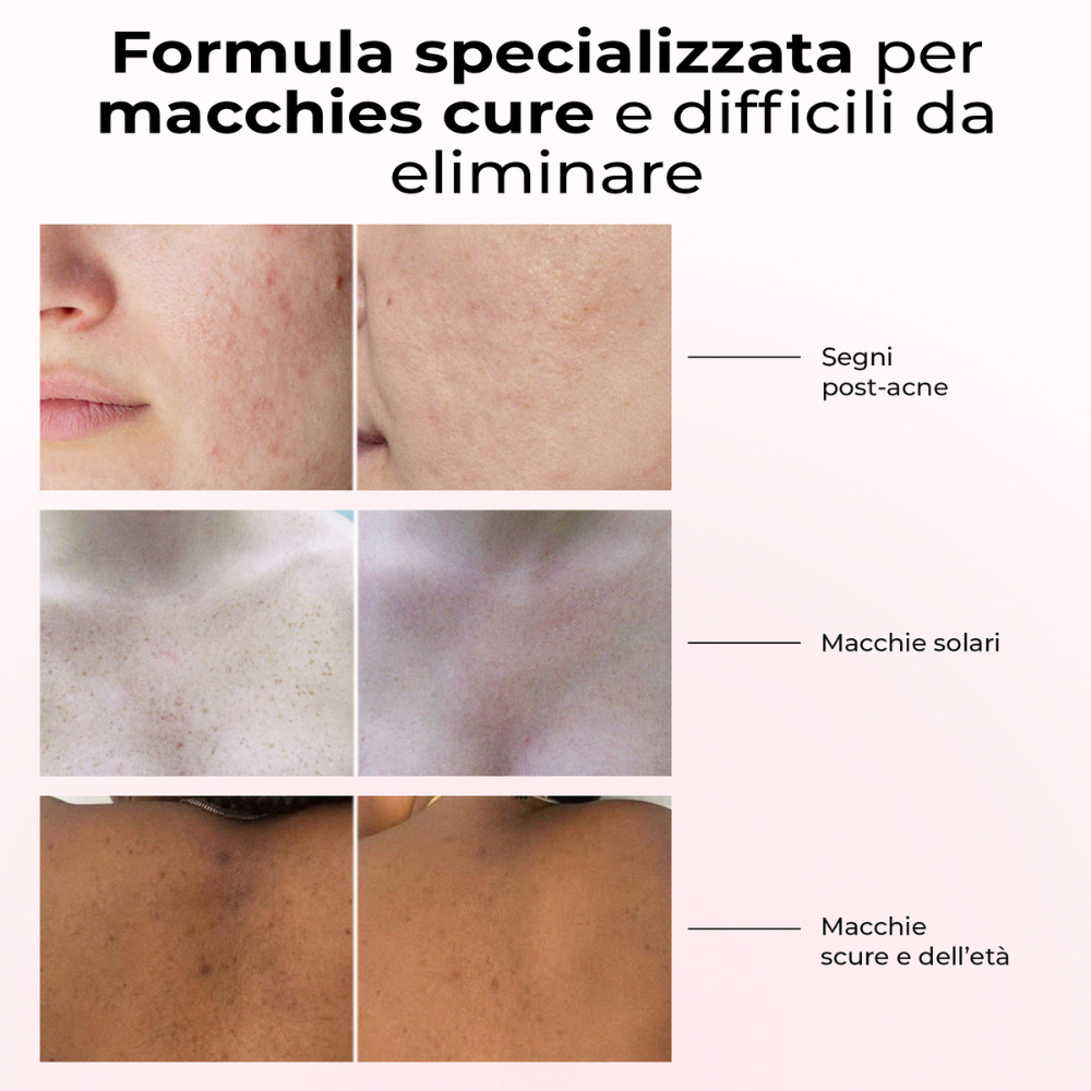 Risultati del siero Lumisilk su macchie ostinate: segni post-acne, macchie solari e macchie scure legate all’età. Formula illuminante e uniformante.