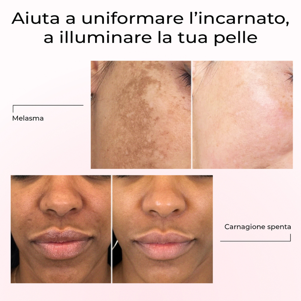 Risultati prima e dopo con il siero Lumisilk: attenua il melasma e illumina la carnagione spenta, uniformando l’incarnato.