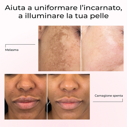 Risultati prima e dopo con il siero Lumisilk: attenua il melasma e illumina la carnagione spenta, uniformando l’incarnato.